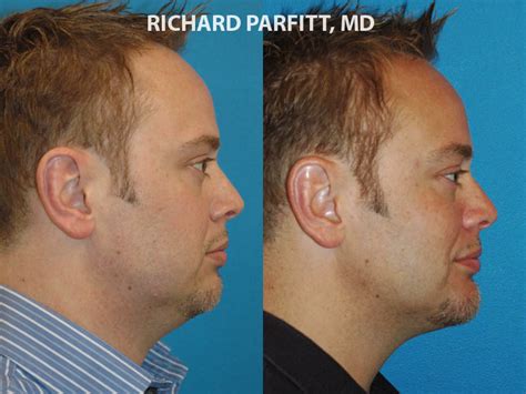 Male Jaw Implant Before And After