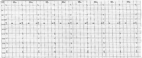 A 24 Hour Ecg Recording Showing Second Degree Atrioventricular Block