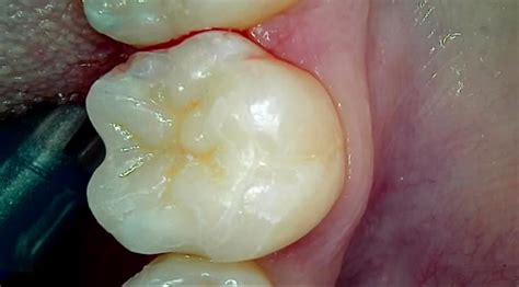 Cas Clinique Onlay La D Fense Dentiste Dr Fran Ois Lescuyer