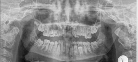 Orthodontic Considerations for Interceptive Extraction of First Molars ...