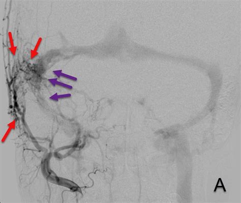 Fistules artério veineuses durales FAVD Universitätsinstitut für