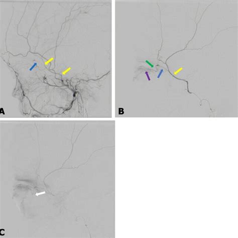 A And B Digital Subtraction Angiography Of The Right External Carotid