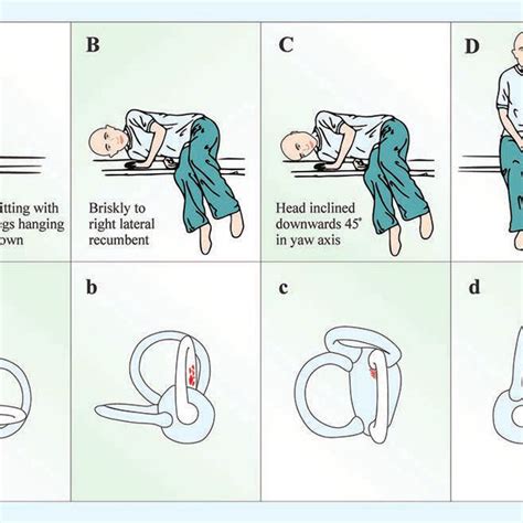 Gufoni maneuver for the left posterior arm horizontal semicircular ...