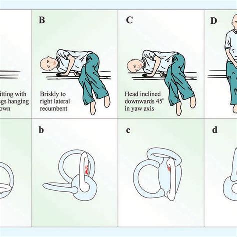 Gufoni Maneuver For The Left Posterior Arm Horizontal Semicircular