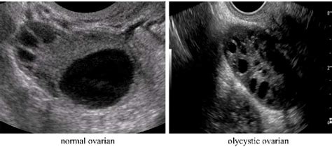 Figure 1 From Follicle Detection Model On Ovarian Ultrasound Image