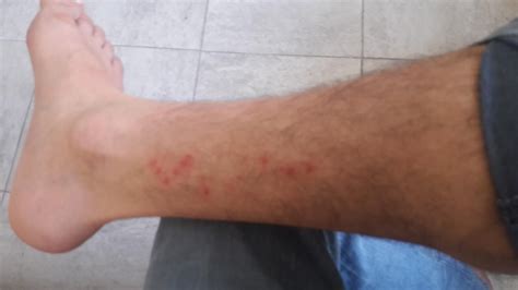 I Saw This Today Is This Hiv Symptoms Rhiv
