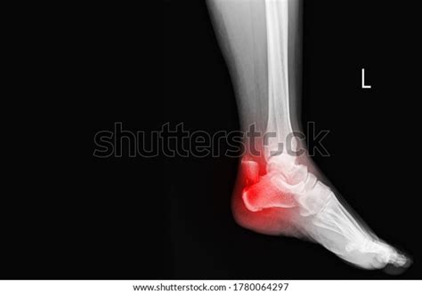 Film Ankle X Ray Radiograph Showing Heel Stock Photo 1780064297