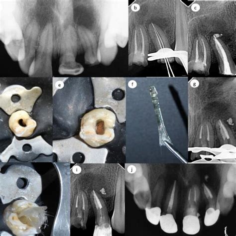 A Pre Operative Occlusal Radiograph Of Tooth And Tooth B