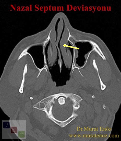 Health Zone Turkey: Nasal Bone Spur - Symptoms, Diagnosis, Treatment