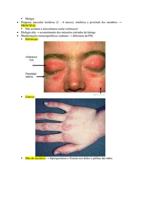 SOLUTION Miopatias Inflamat Rias Idiop Ticas Studypool