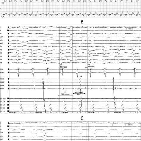 Panel A 12 Lead Electrocardiogram Of The Presenting Tachycardia Download Scientific Diagram