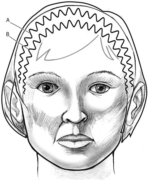 Techniques In Facial Reanimation—upper Eyelid And Eyebrow Operative