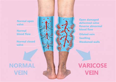 Vein Treatments - Vein Specialists of the Carolinas treat thousands yearly