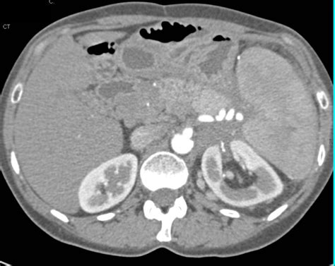 Pancreatic Cancer Encases The Pv Smv Confluence With Extensive