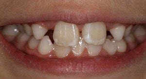 Common Appearance Of Dental Enamel Hypoplasia Commonly Referred To As