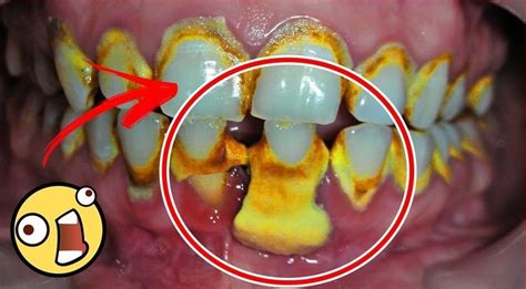 Como Remover A Placa Bacteriana Em Minutos Sem Ir Ao Dentista Embora