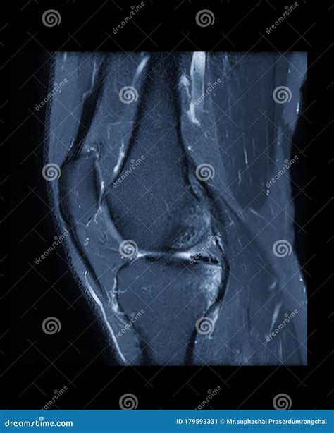 Compare Of Mri Knee Or Magnetic Resonance Imaging Of Knee Joint Stir