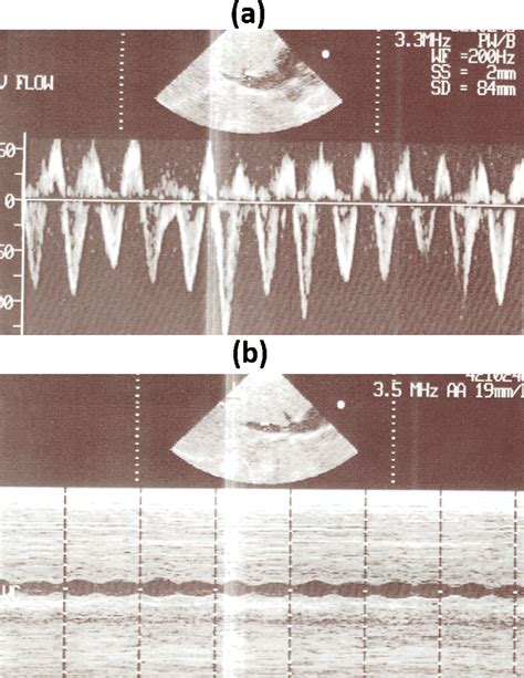 A Doppler Evaluation Of Hepatic Vein Showing Blunted Forward Flow And