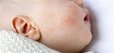 Brotoeja em bebê: como reduzir o desconforto dos pequenos