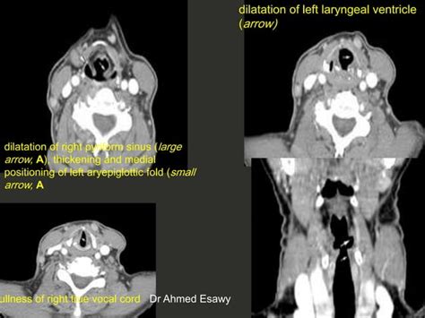 Larynx Imaging 4th Part Virtual Laryngoscopy Vocal Cord Paralysis Ct Mri Dr Ahmed Esawy Ppt