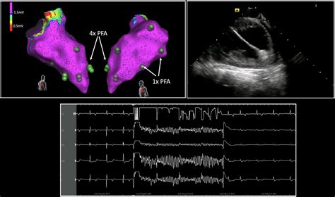 Pulsed Field Ablation In Ventricular Myocardium Using A Focal Catheter