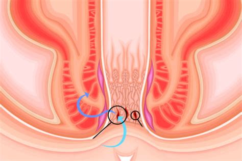 Fissure Anale CCGD Chirurgie Digestive Lyon