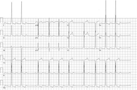 Not Your Usual Pre Excitation Circulation