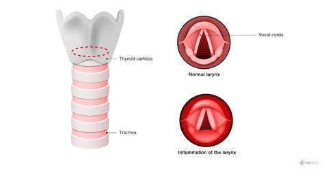 Laryngitis Types Symptoms Causes And Treatment