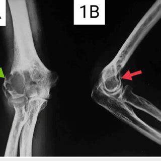 A Anteroposterior Radiograph Of The Right Elbow At The Time Of