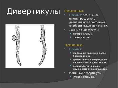 Заболевания пищевода. Смещения пищевода. Дивертикулы. Инородные тела ...