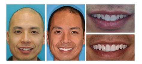 Gallery Before And After Downtown Dentistry Toronto On