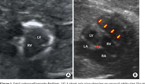 Figure From A Congenital Annular Pericardial Fibrous Band Diagnosed