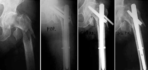 Figure From Treatment Of Extracapsular Hip Fractures With The