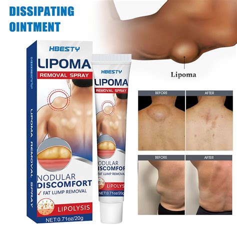 G Lipoma Removal Cream For Adults Instant Lumpfree Lipoma Removal