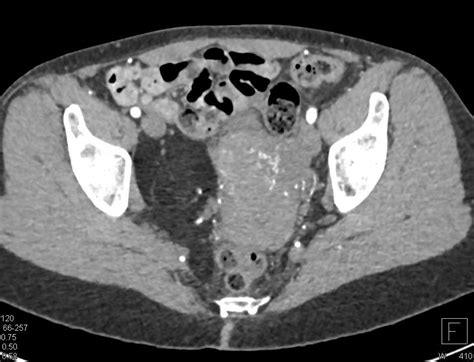 Liposarcoma Pelvis Musculoskeletal Case Studies Ctisus Ct Scanning