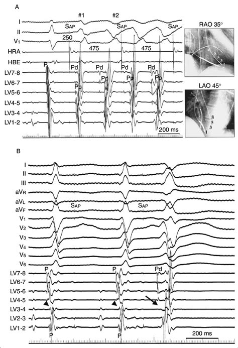 Electrograms Recorded Before And After Ablation Of Polymorphic Vt