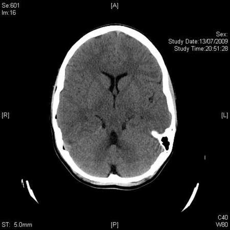 Pneumocephalus - RCEMLearning