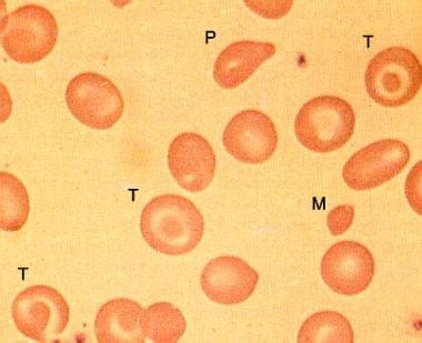 Beta Thalassemia Practice Essentials Etiology Epidemiology