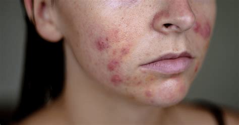 Hormonal Acne Treatment Clear Skin In 4 Months