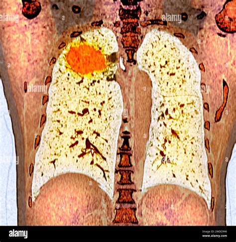 Ct von lungenkrebs Fotos und Bildmaterial in hoher Auflösung Seite