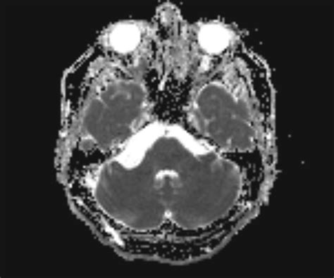 Arachnoid Cyst Cerebellopontine Angle Image Radiopaedia Org