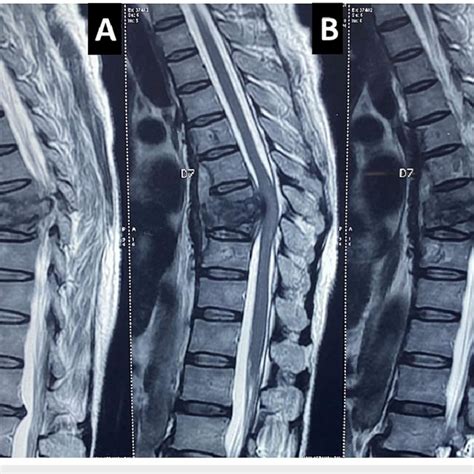 A B And C Sagittal View T2 Weighted Mri Of The Thoracic Spine Download Scientific Diagram