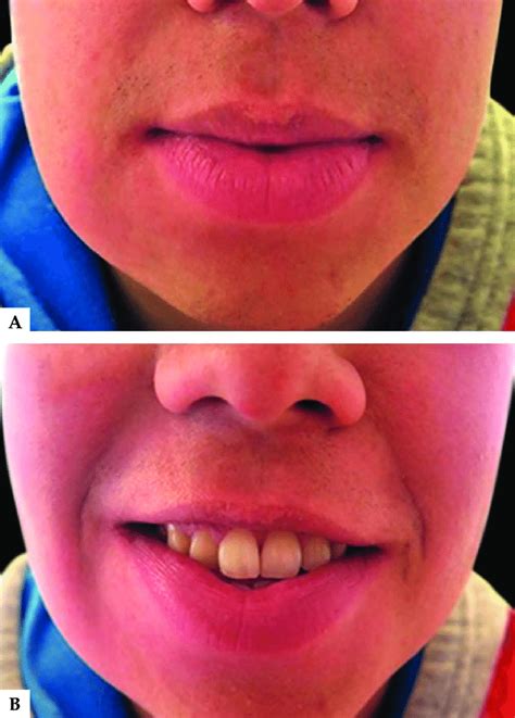 Patient 1 At 18 Month Follow Up A Asymmetrical Lower Lip Swelling Download Scientific