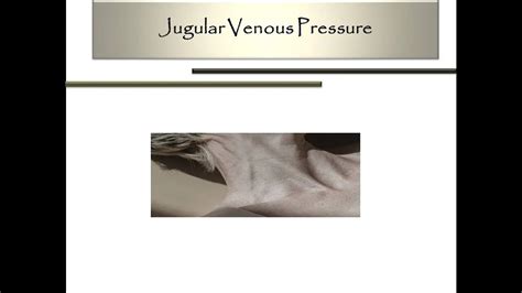 Examination of Jugular Venous Pressure and JVP waveform.