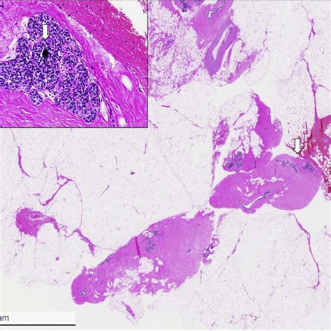 Histological Appearance Of Classical LN Vacuum Assisted Biopsy