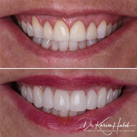 Porcelain Veneers Sydney Best Composite Dental Veneers Sydney