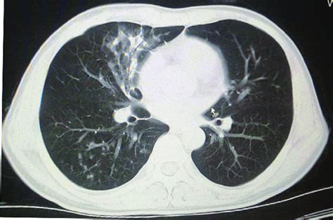 Ct Scan Of Chest Showing Fibrotic Changes And Nodular Opacities And