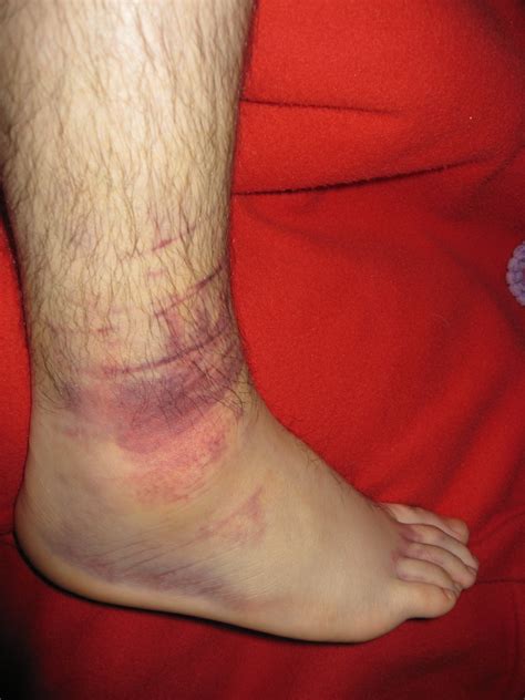 Ankle Swell And Internal Bleeding Ankle Swell And Internal Flickr