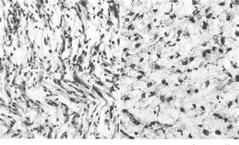 Figure 1 From Reticulin Stain In Differentiating Astrocytomas From