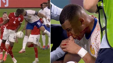 EURO 2024 fracture du nez pour Mbappé il devra porter un masque